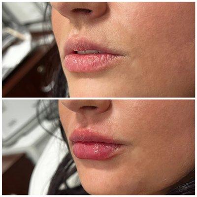 1mL lip enhancement