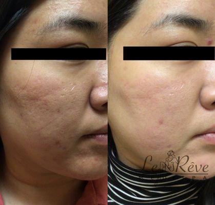 Vivace microneedling and Picosure laser for acne scars.