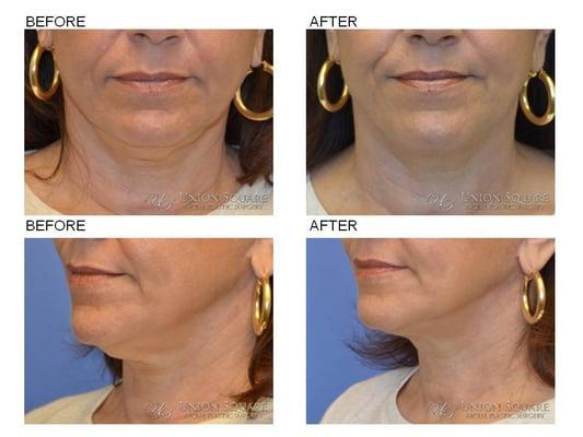 Revision Necklift performed by Dr. Chiu-Collins