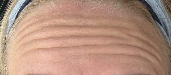 Forehead BEFORE Jeuveau treatment