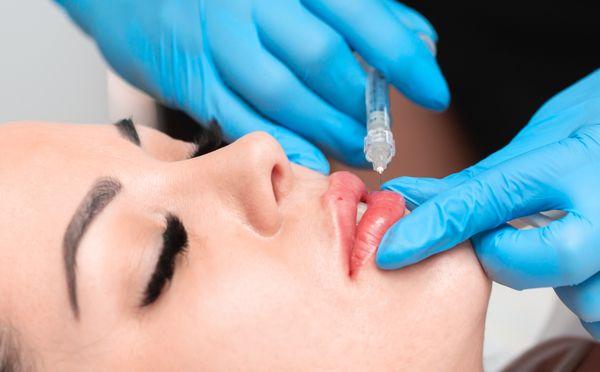 Lip plumping with hyaluronic acid fillers