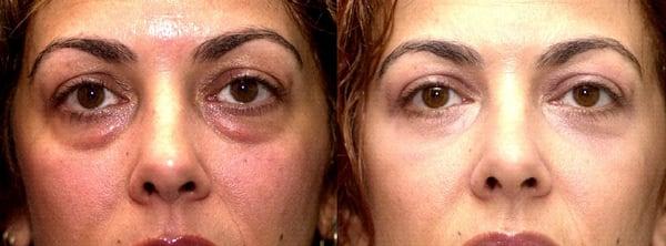 Lower Eyelid Bag Surgery by Sadove