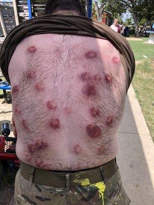 The result of a petulant adult peppering my back with a speedball paintball gun from 10 feet away.