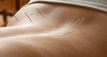 Acupuncture for Back Pain