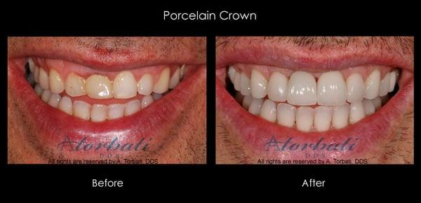 Full Mouth Implant Reconstruction