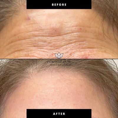 Smoothed out forehead lines after tox treatment.