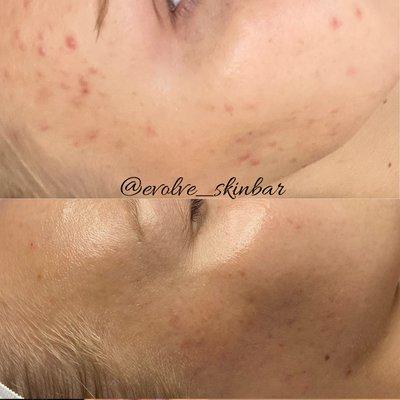 Acne  and acne scar removal is what owner Kimberly has become well known for