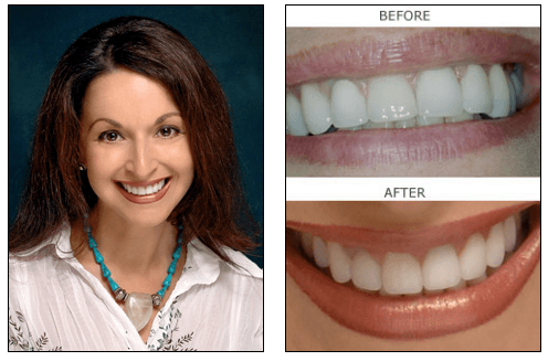 Porcelain veneers patient