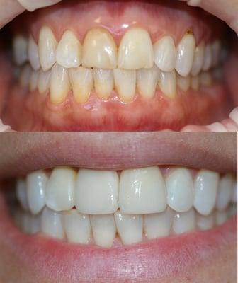 Veneers before and after