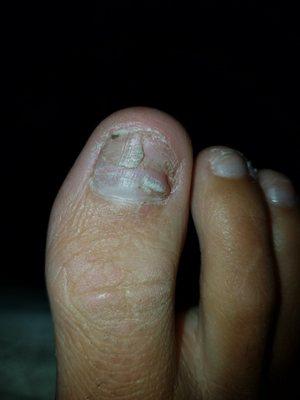 Infected toe nail from UR Nails & Spa. Awful!!!!!