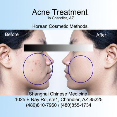 Acne Treatment