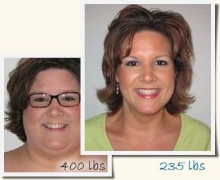 KIm - Roux-en-Y Gastric Bypass before and after