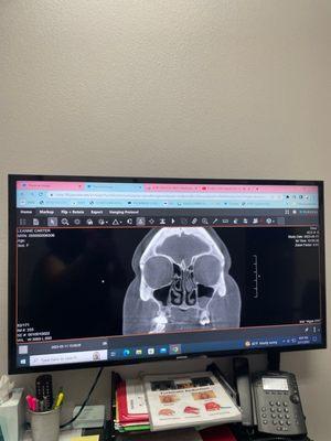 My CT scan, everything that is grey around my nose was infection