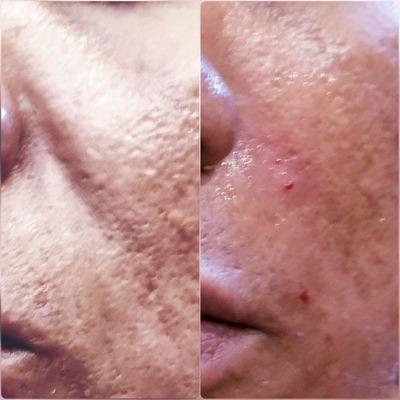 Before and after Juvederm filler.  Actual client.