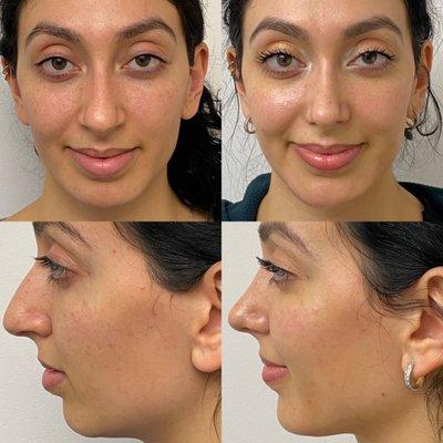 2 1/2 months after rhinoplasty and chin enhancement