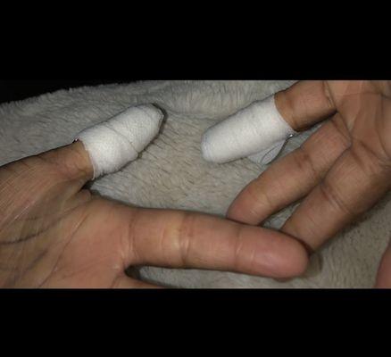 2 drill-burnt natural nail beds wrapped in ointment-covered gauze for healing and pain.