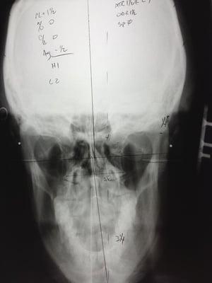 Precision X-rays of an Atlas subluxation