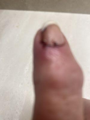 Right hand index finger three months after initial nail infection