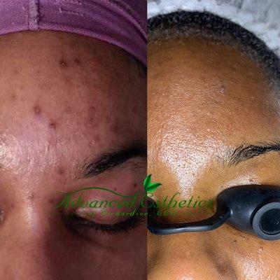 Acne Clearing Facial and Face Reality Skincare offered at Advanced Esthetics of Richardson