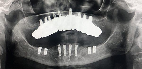 Lower arch missing teeth. 8 implants used to reconstruct the arch followed by 3 months of healing.