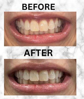 30 Minute Teeth Whitening