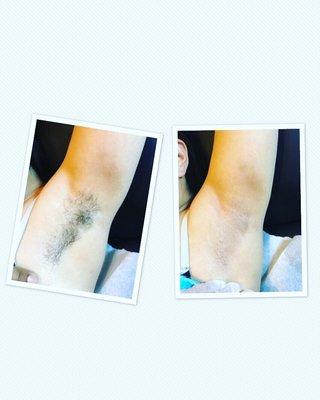 Before and after Underarmwax