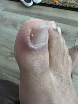 My infected toe and water coming out of it after days of treating it.