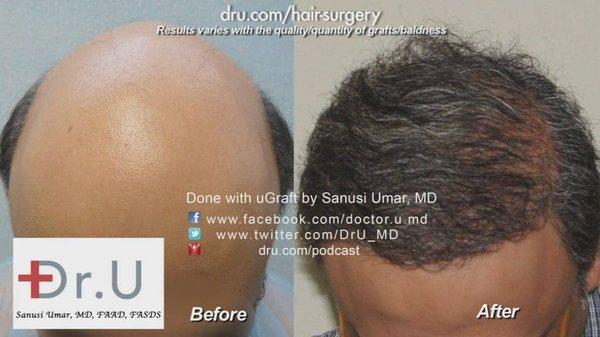 NW 7 Baldness (Norwood Level 7) Hair Restoration Results in Los Angeles with Dr. Umar V1