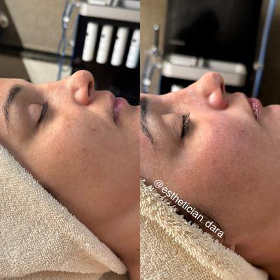 Before and after from a custom facial. Check out the instant hydration in the under eyes!