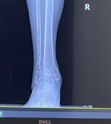 After metal plate and 8 screws taken out from Tibia and Fibula