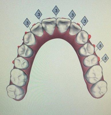 Invisalign post-treatment.