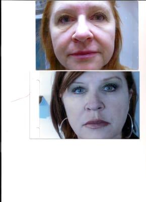 before and after juvederm injections