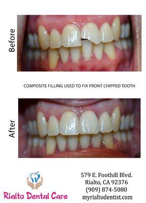 Case of the Month: An emergency patient who walked in with a chipped front tooth is back to smiling after being in an out in an hour!