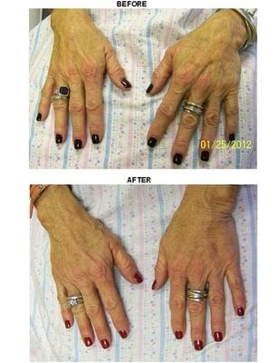 Hands Rejuvenation w/Radiesse