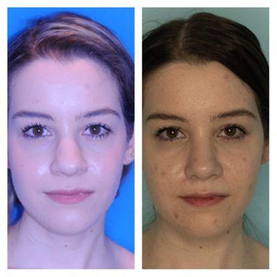 Before having any surgery (Left) and after having a primary rhinoplasty with Dr. Clymer (Right)