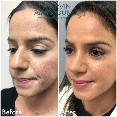 This patient felt her nose was too big and bumpy for her face. After her rhinoplasty, she had no bruising & feels more happy and feminine.