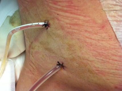 Drain tubes sewn into my abdomen after Wong almost killed me. My life has never been the same. Stay away from this Dr!