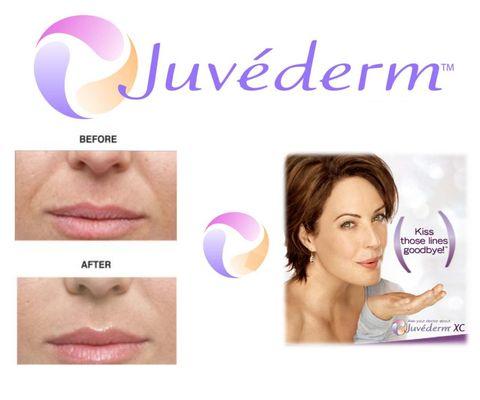 JUVÉDERM® is the #1 selling collection of hyaluronic acid fillers in the USA. Each product in the JUVÉDERM® collection adds volume to differ