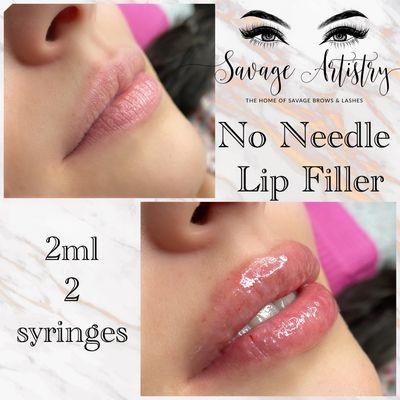 Hyaluron lip filler