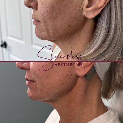 Morpheus8 RF microneedling, skin tightening, facial contouring, revision skincare