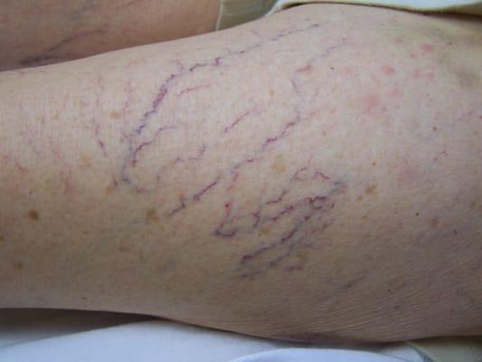 before spider vein treatment with sclerotherapy