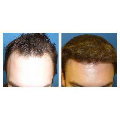 2000 grafts frontal hairline