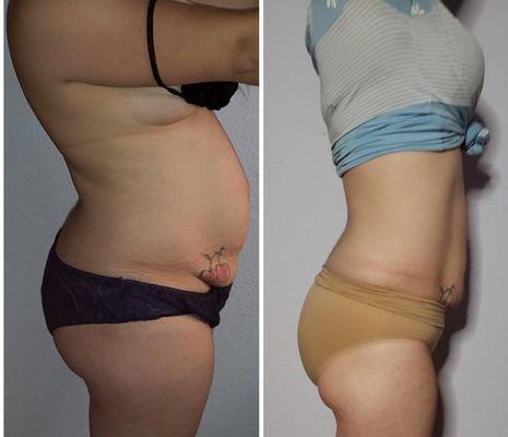 10 Cryoskin Slimming Sessions Results