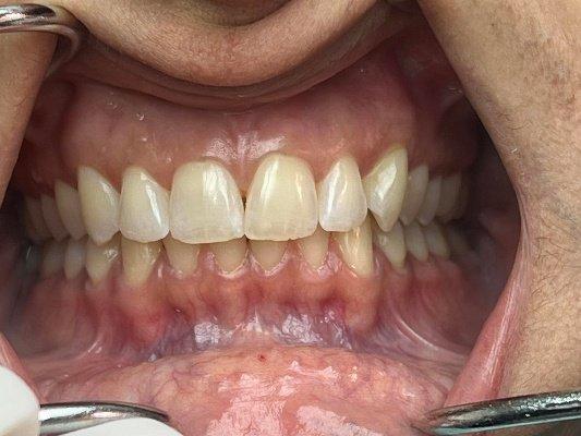 Invisalign After