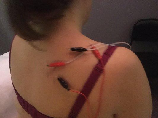 Acupuncture electroacupuncture treatment