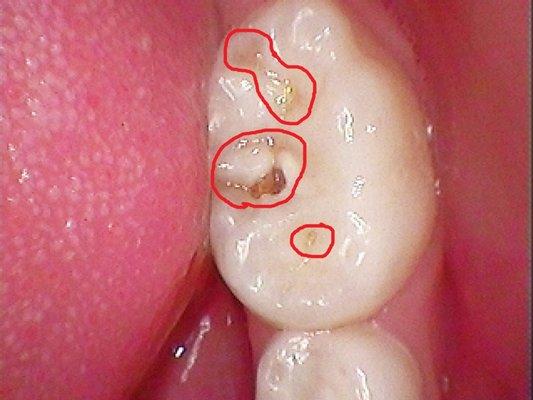 Primary molars of two different patients, 3 years old, with significant decay.....young children should start having dental check ups at 1 y