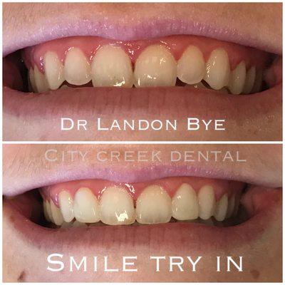 SMILE TEST DRIVE  to show off how making the two lateral teeth, next to the middle teeth, a little larger makes a smile more symmetrical.