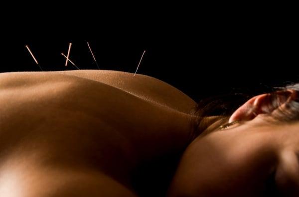 Woman receiving acupuncture at Westminster Community Acupuncture.