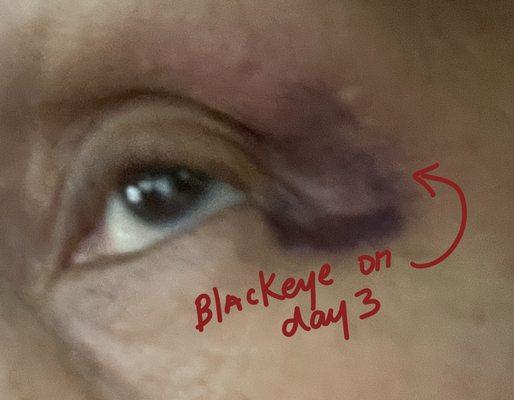 Blackeye, not including back and neck pain