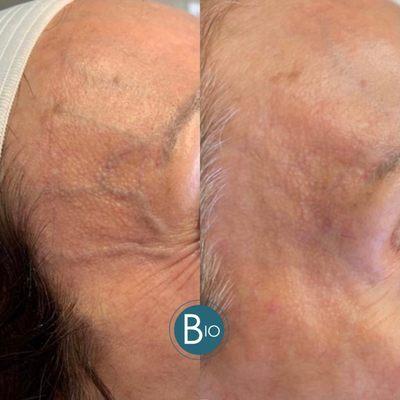 Before & After Vein Treatment